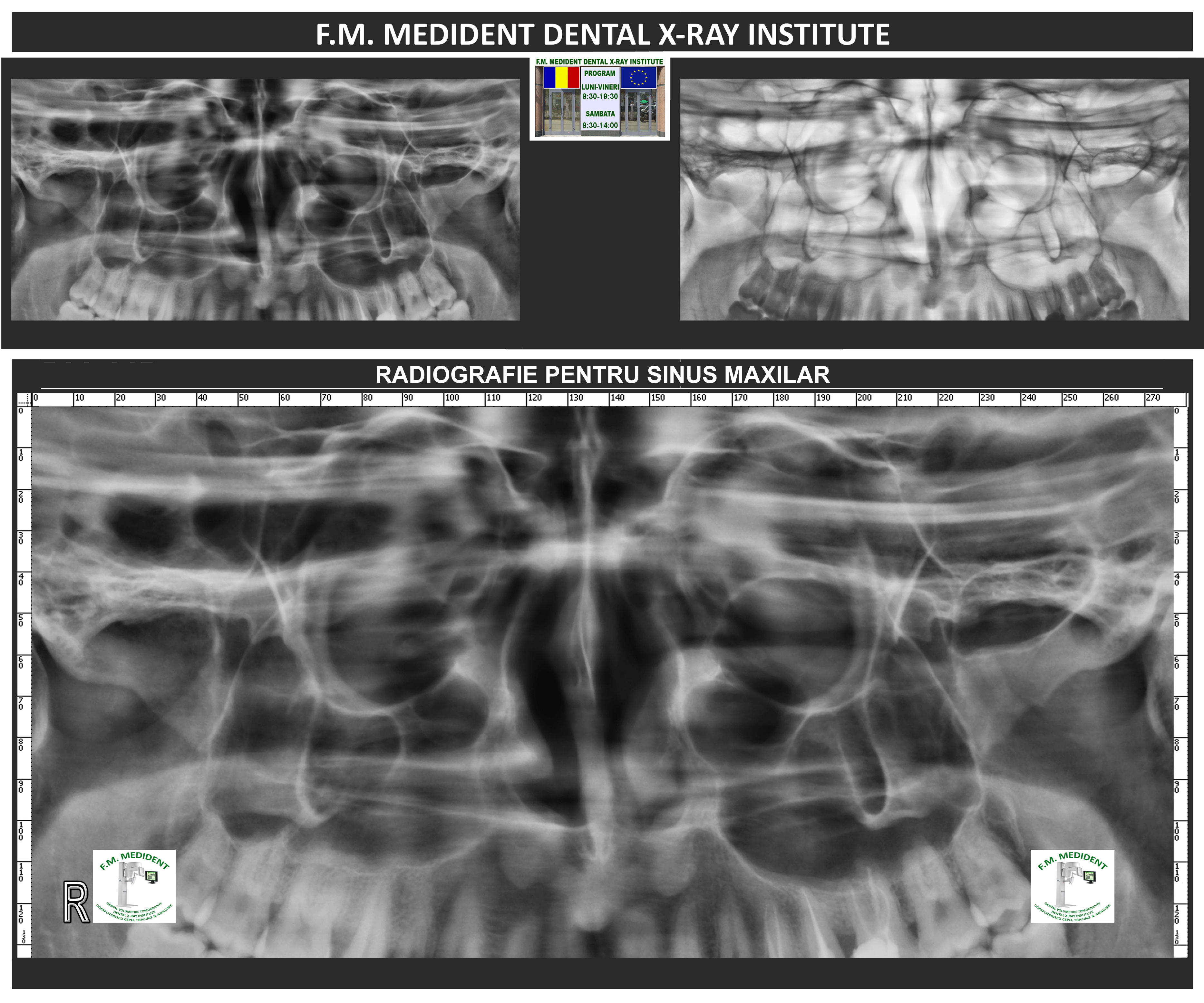 Maxillary sinus radiography